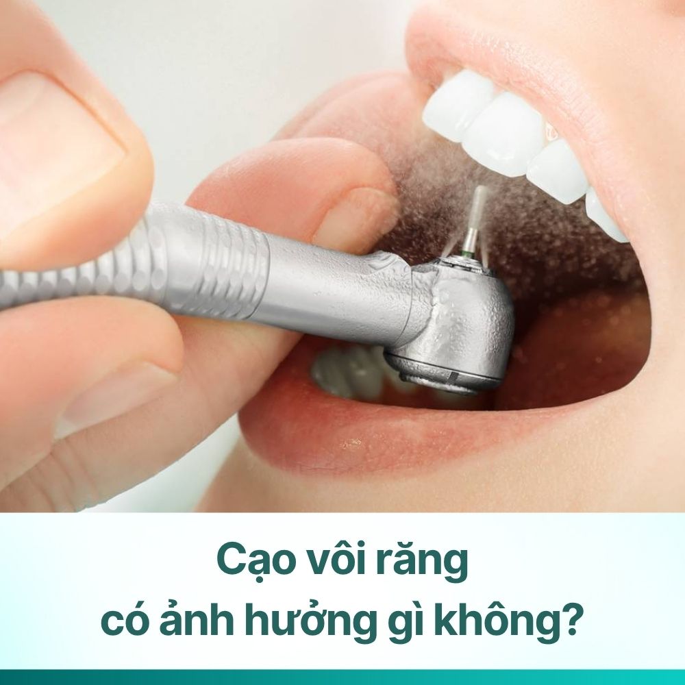 Cạo vôi răng có ảnh hưởng gì không? Có lợi hay gây hại?