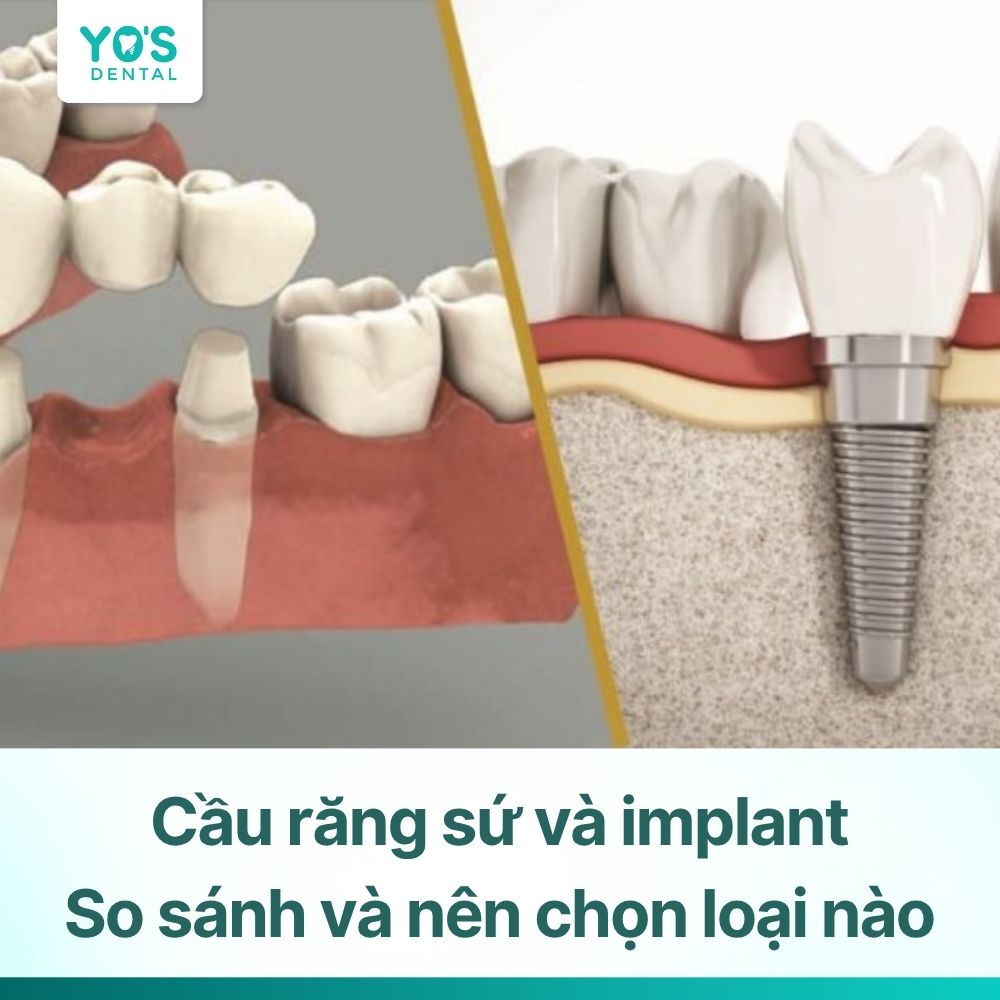 So sánh cầu răng sứ và Implant: Nên chọn loại nào?