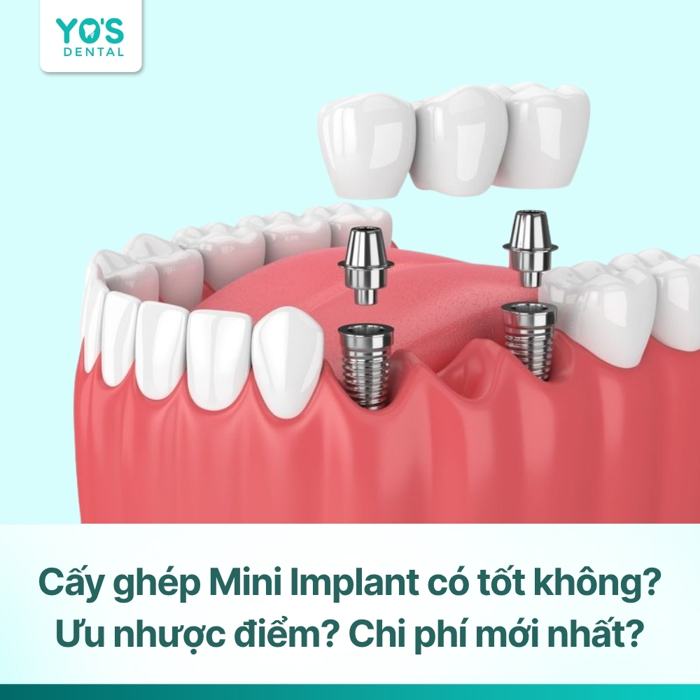 Cấy ghép Mini Implant có tốt không? Ưu nhược điểm, chi phí mới nhất