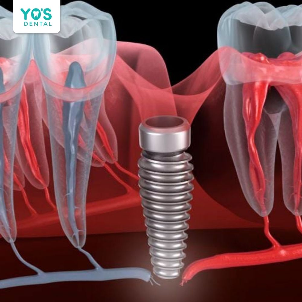 Bác sĩ thực hiện các bước thăm khám, chuyên môn cao trước khi đặt trụ Implant vào xương hàm