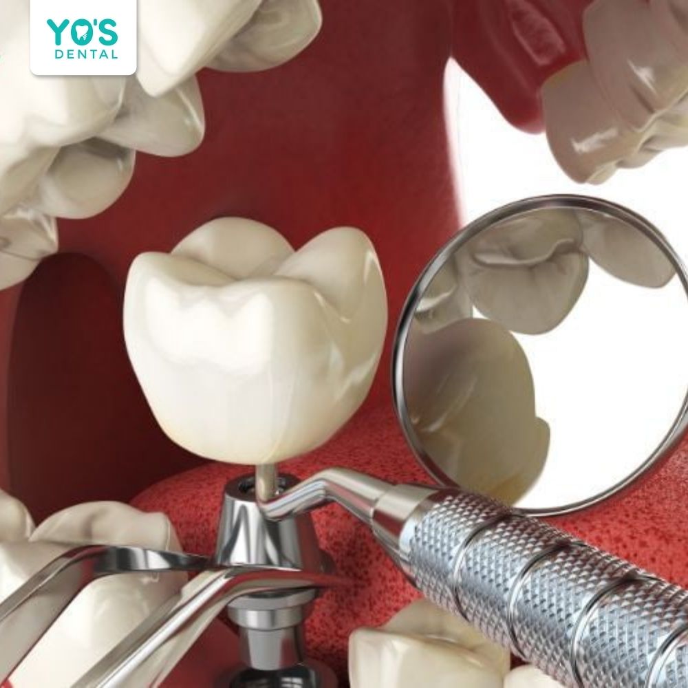 Tùy vào tình trạng xương hàm và mức độ phức tạp của từng ca, mới tiến hành tiếp giai đoạn 2