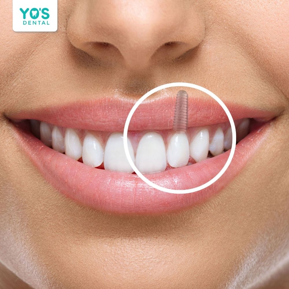 Thời gian chờ 3-9 tháng giúp trụ Implant tích hợp ổn định để gắn răng sứ
