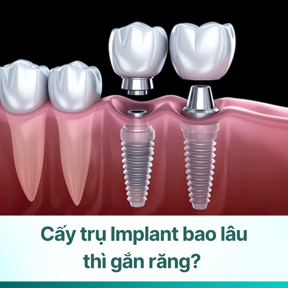 Cấy trụ Implant bao lâu thì gắn răng? Toàn bộ quy trình cắm Implant