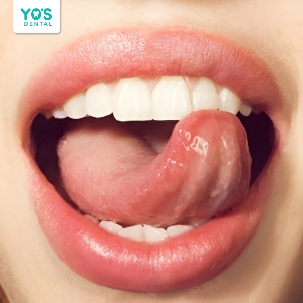 Dùng lưỡi đẩy răng là một phương pháp dân gian tự điều chỉnh răng hô tại nhà.
