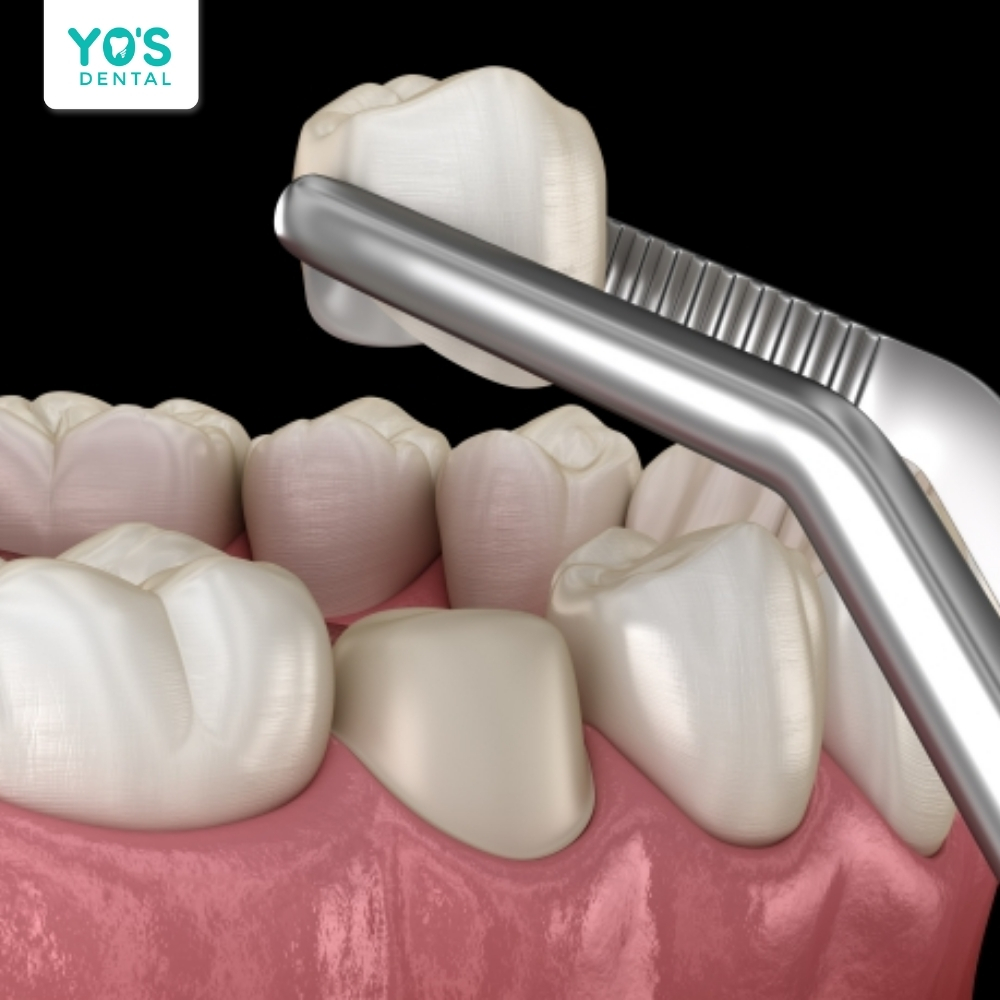 Bọc răng sứ giúp che đi khuyết điểm răng hô và mang lại nụ cười trắng sáng.