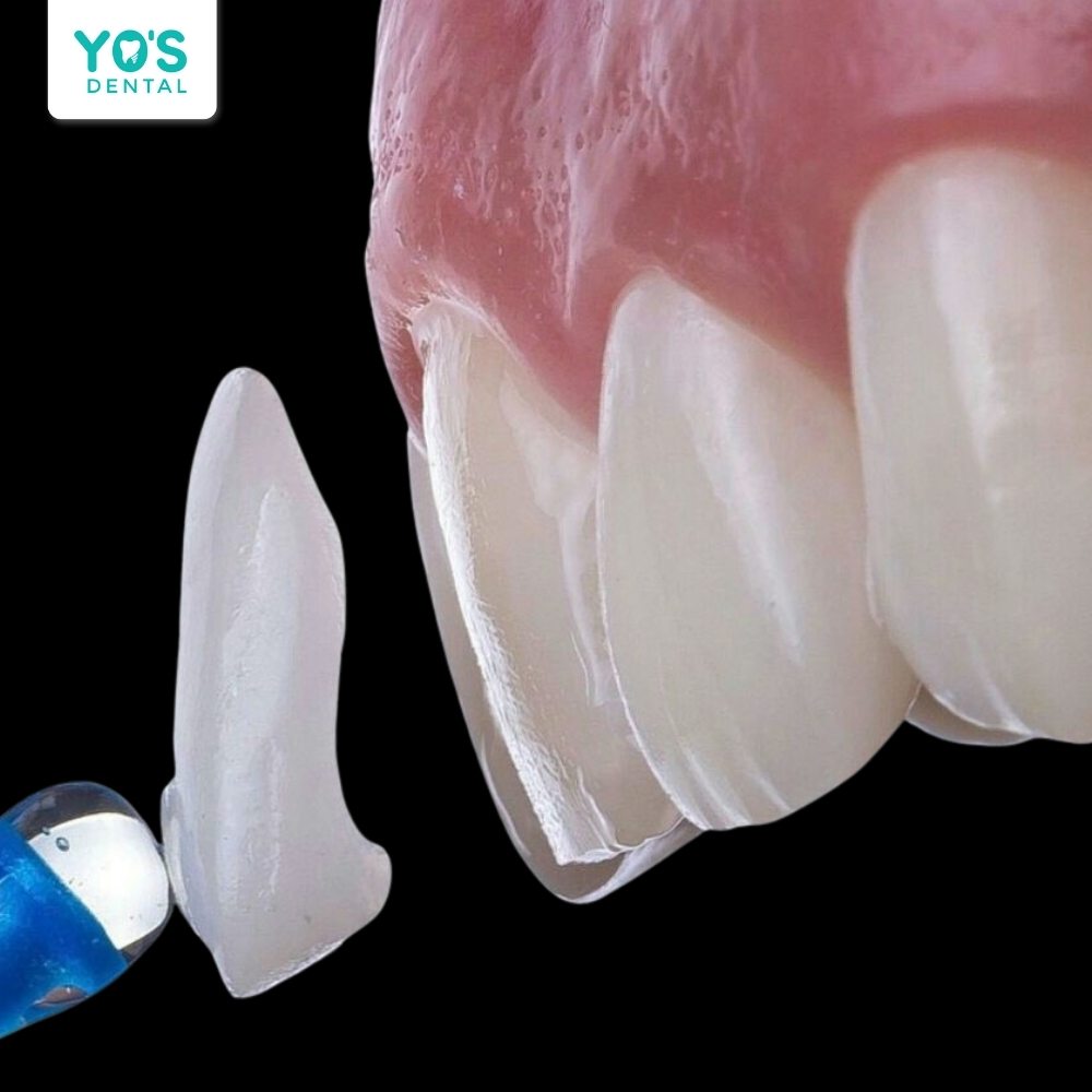 Veneer sứ mang lại vẻ đẹp tự nhiên và che phủ khuyết điểm răng hô.