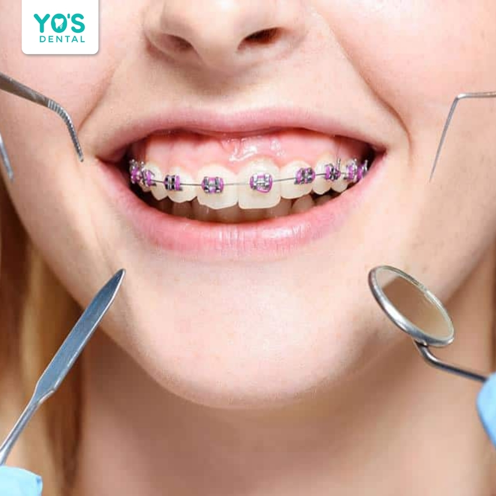 Niềng răng là giải pháp tối ưu cho tình trạng răng hô do lệch lạc, hô nhẹ do răng.