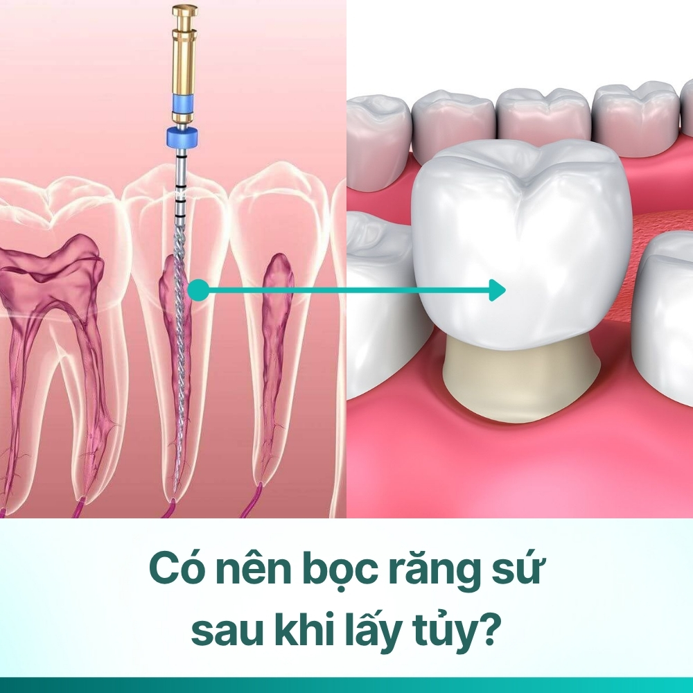 Có nên bọc răng sứ sau khi lấy tủy? 5 điều cần biết
