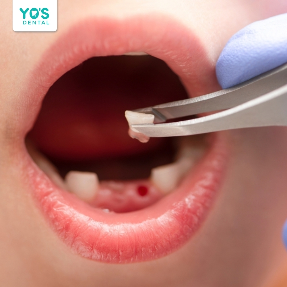 Giữ lại răng sữa của bé là món quà sức khỏe quý giá cho tương lai.