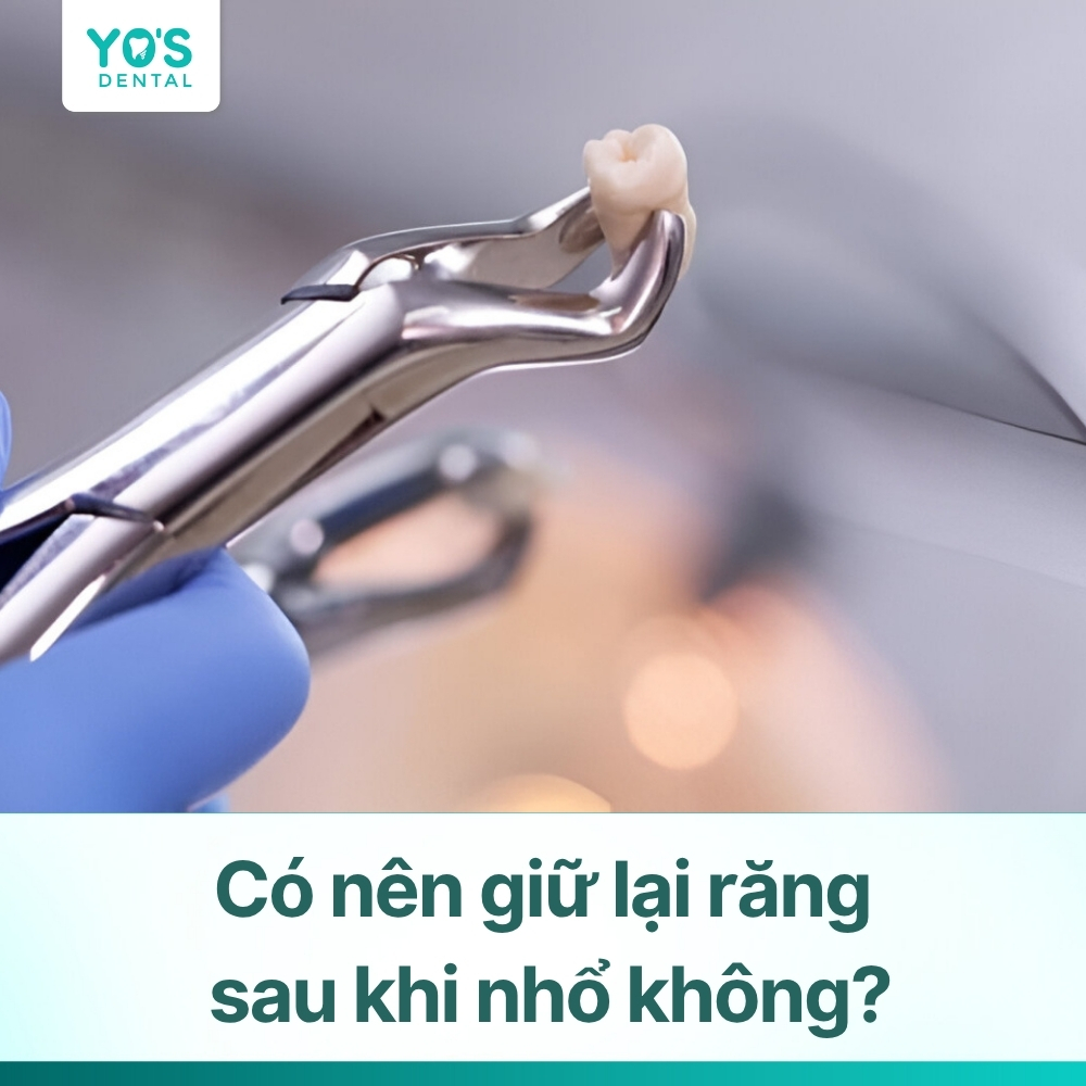 Có nên giữ lại răng sau khi nhổ không? Giải đáp từ chuyên gia Yo's Dental