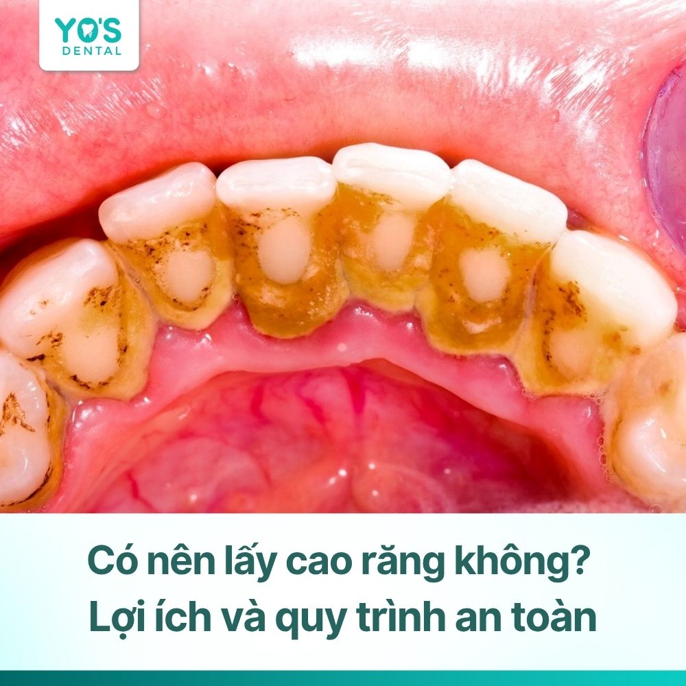 Có nên lấy cao răng không? 8 lợi ích và quy trình an toàn