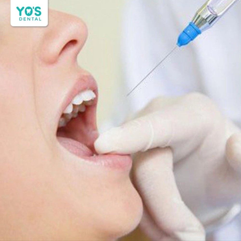 Điều trị cười hở lợi bằng phương pháp tiêm botox