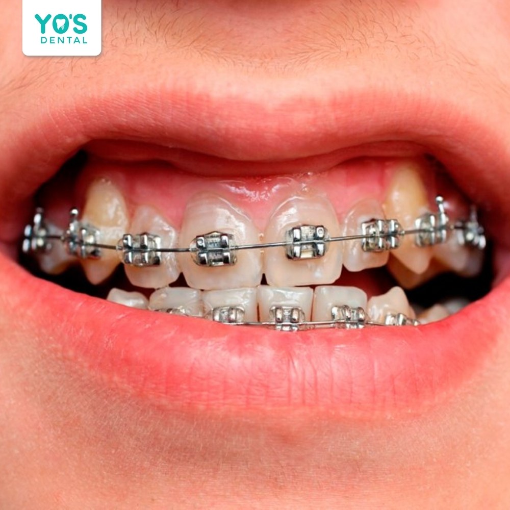 Niềng răng có thể chữa được tình trạng hở lợi nhưng thời gian dài