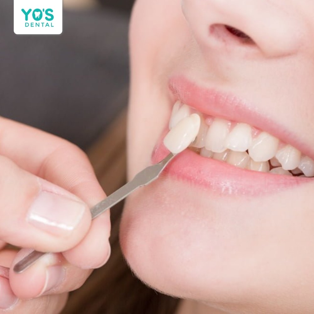 Dán sứ Veneer cũng có thể điều trị tình trạng cười hở lợi hiệu quả