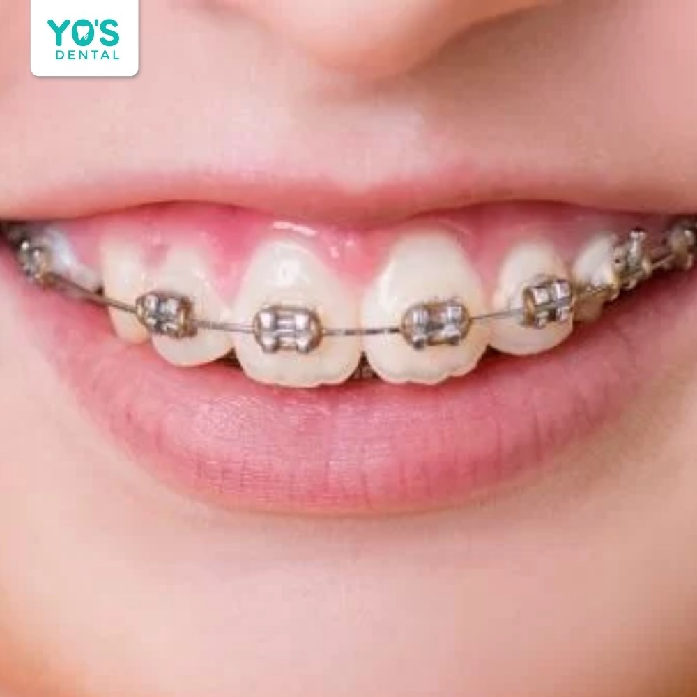 Niềng răng chữa hở lợi mất khoảng 6-18 tháng tùy tình trạng