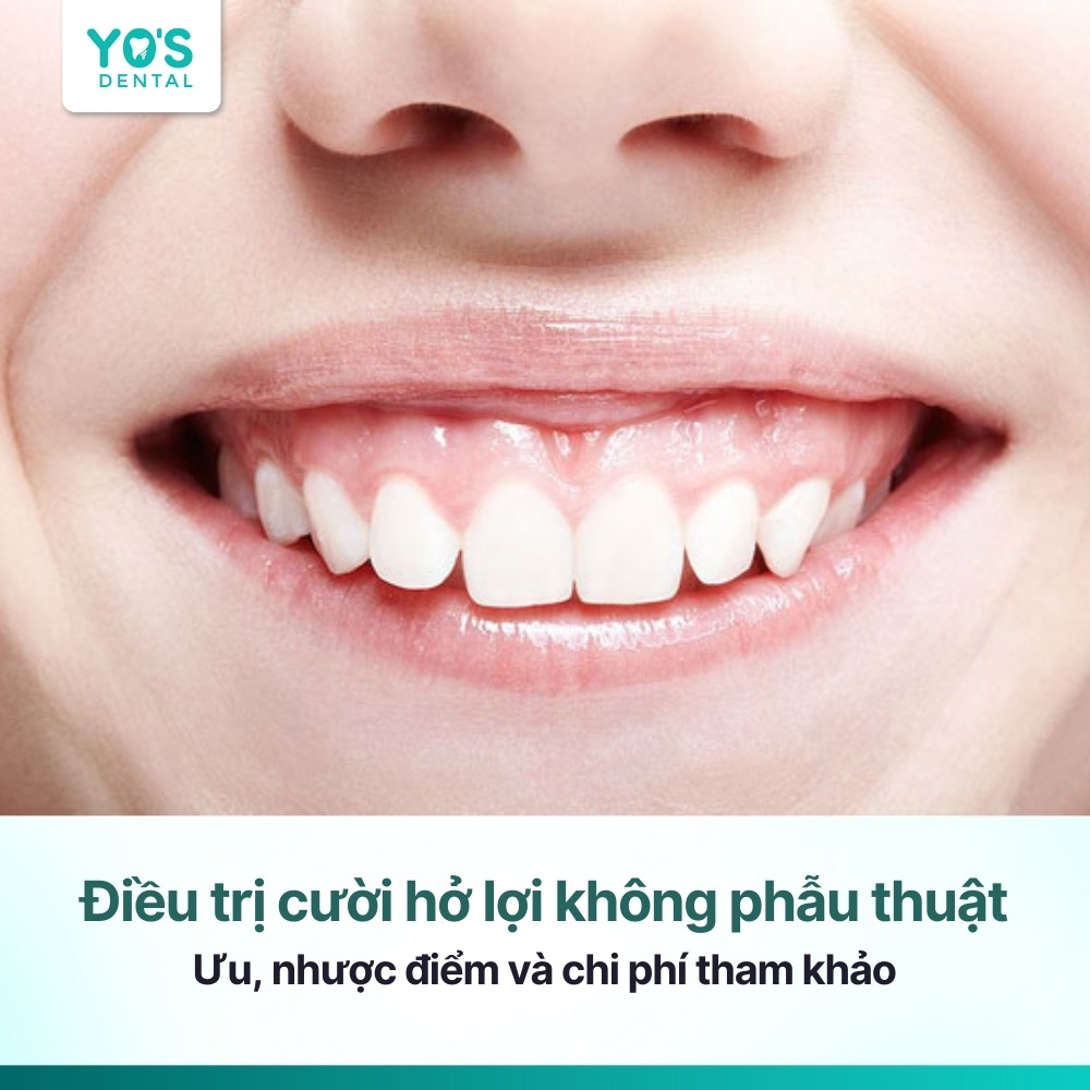 Điều trị cười hở lợi không phẫu thuật: Phương pháp an toàn