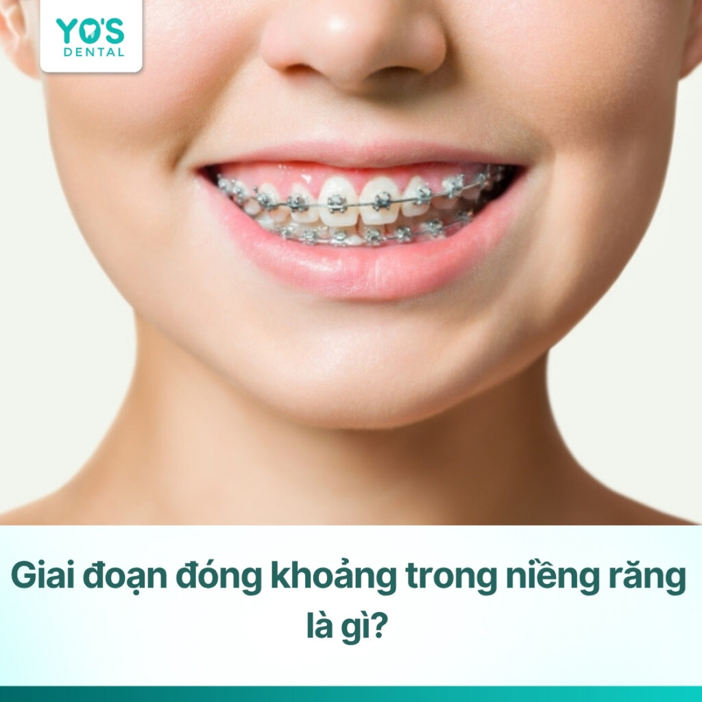 Giai đoạn đóng khoảng trong niềng răng là gì? Mất bao lâu?