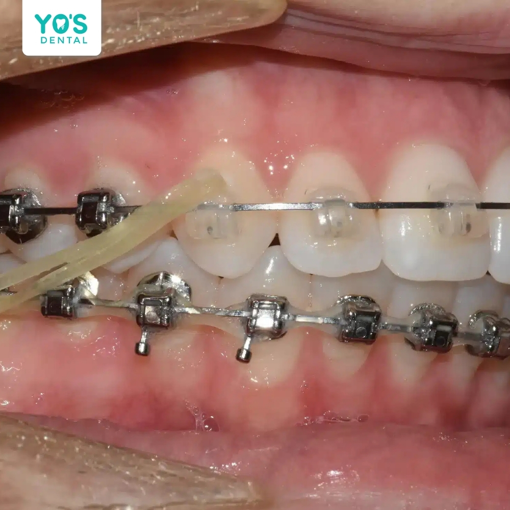 Nha sĩ thu hẹp khoảng trống nhỏ giữa các răng bằng chun
