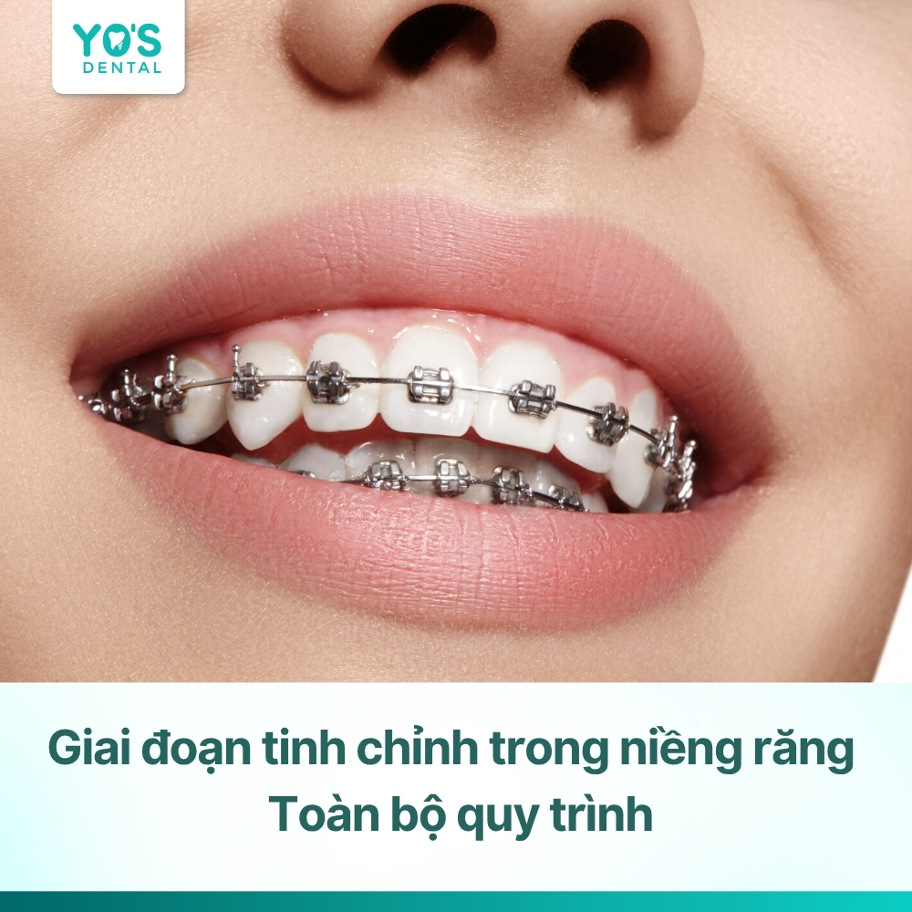 Giai đoạn tinh chỉnh trong niềng răng & Toàn bộ quy trình
