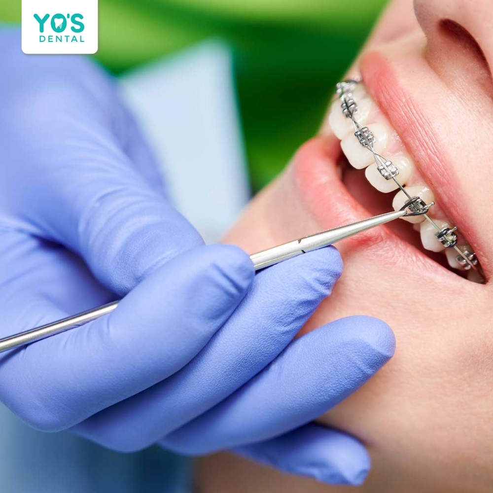 Nha sĩ thực hiện việc lắp đặt khí cụ niềng răng