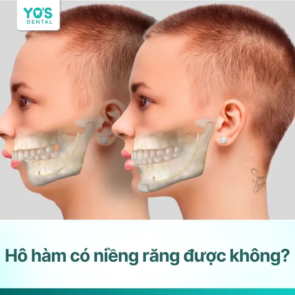 Hô hàm có niềng răng được không? Chuyên gia giải đáp chi tiết