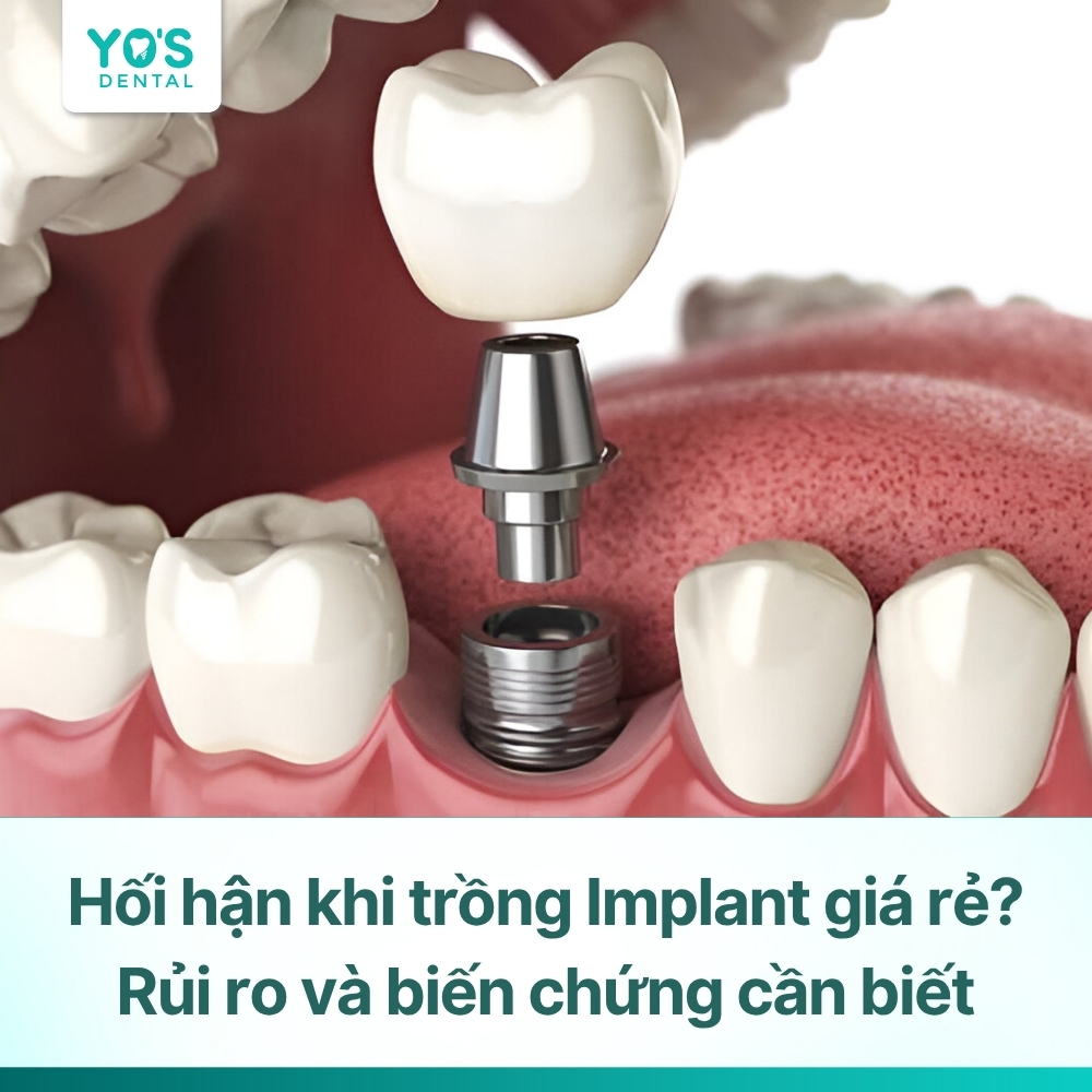 Hối hận khi trồng Implant giá rẻ? Rủi ro và biến chứng cần biết