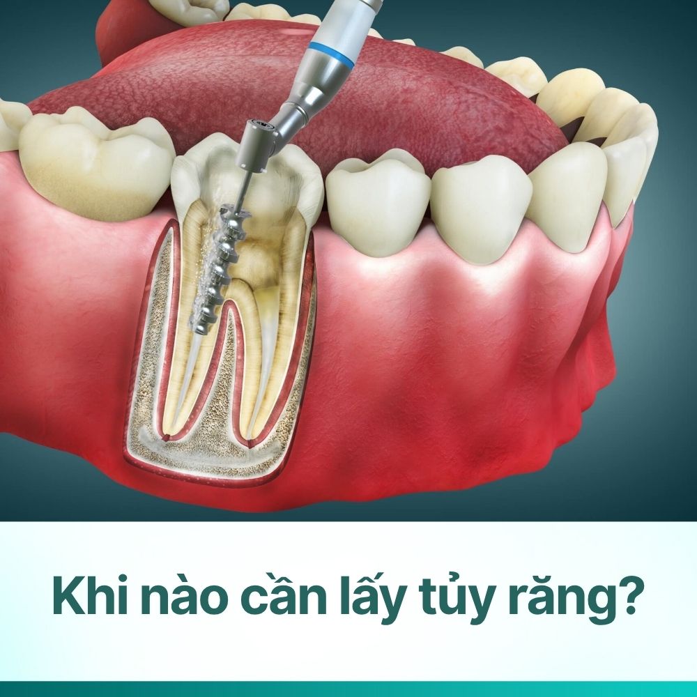 Khi nào cần lấy tủy răng? Dấu hiệu và quy trình chuẩn