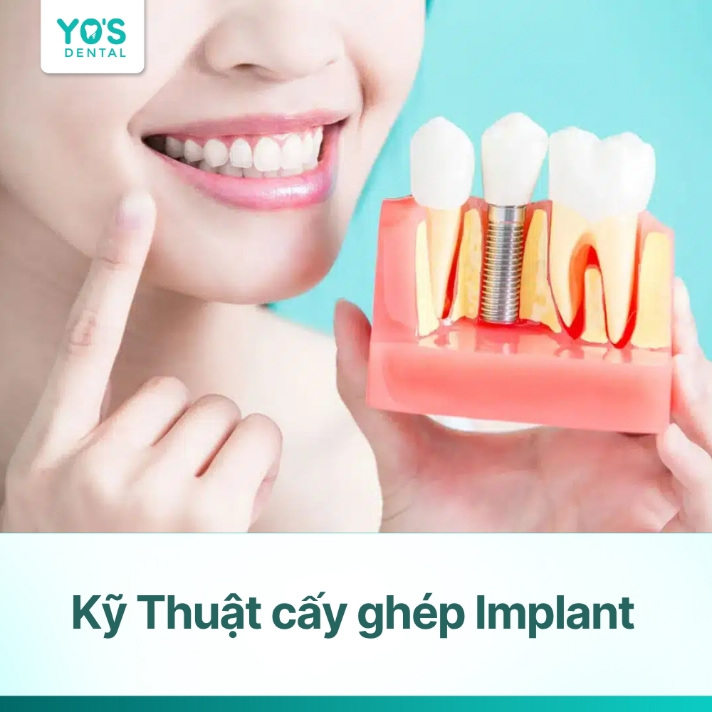 Kỹ thuật cấy ghép Implant: Quy trình từ A-Z & Bảng giá mới