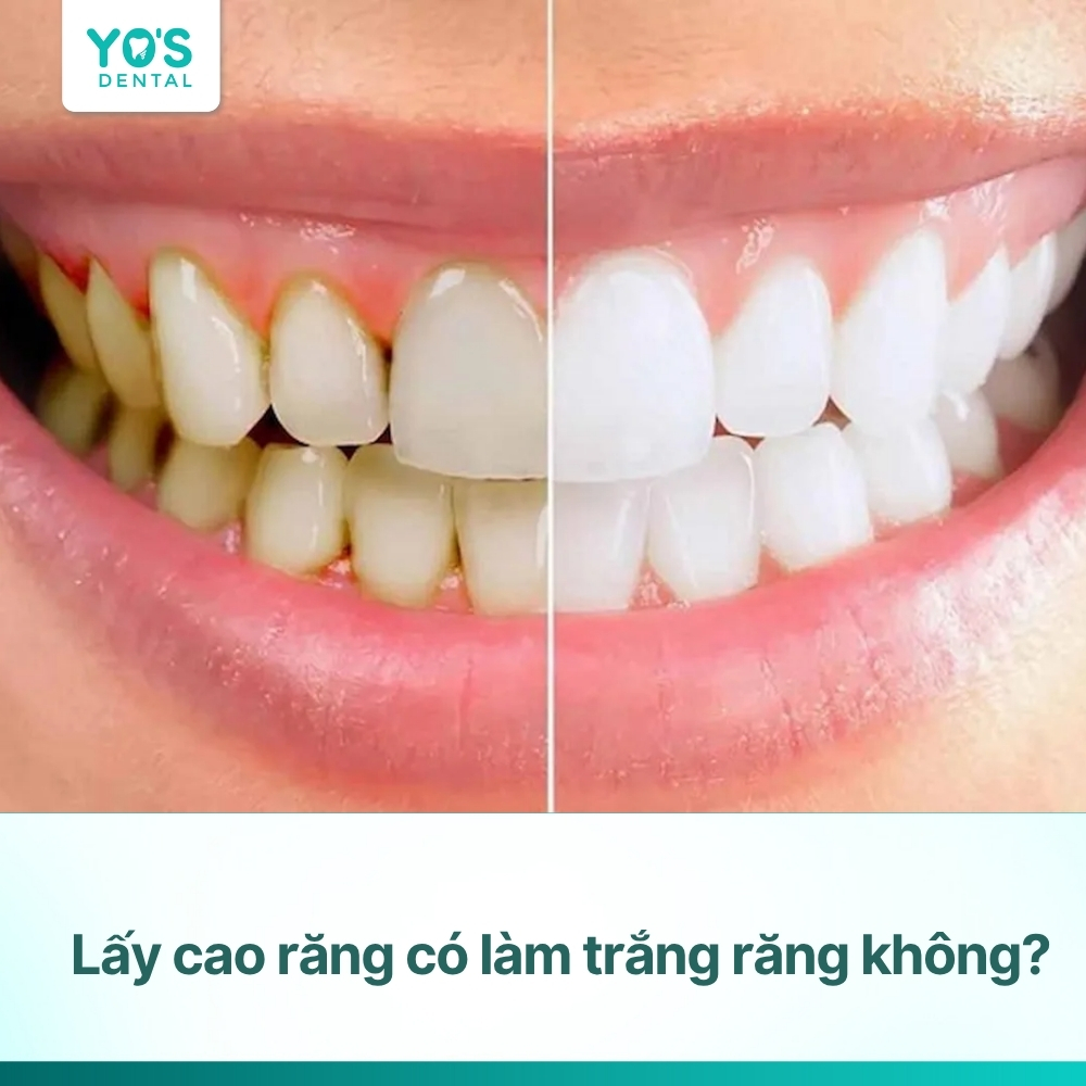 Lấy cao răng có trắng răng không? Giải đáp từ nha sĩ
