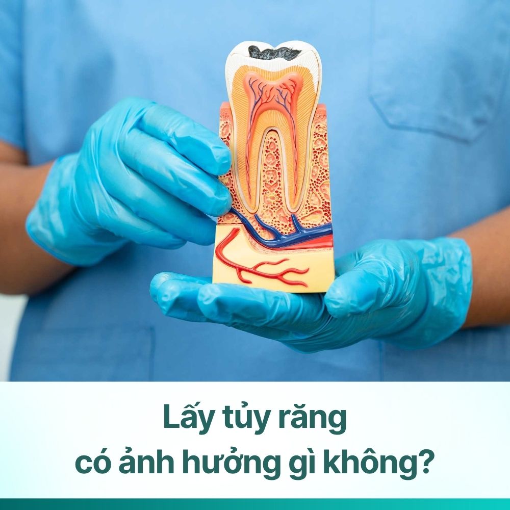Lấy tủy răng có ảnh hưởng gì không? Đừng làm nếu chưa rõ