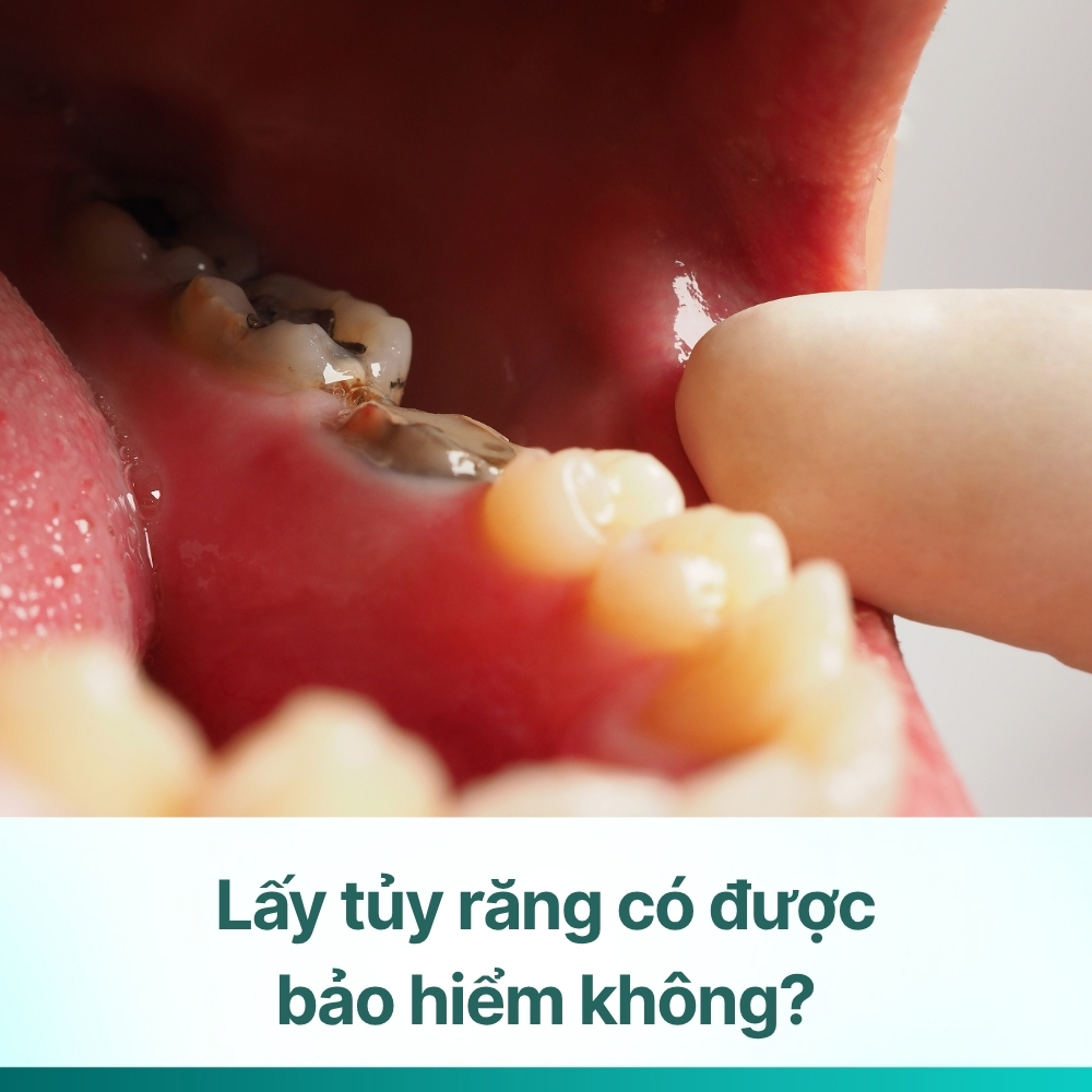 Lấy tủy răng có được bảo hiểm không? Cách dùng BHYT khi lấy tủy răng
