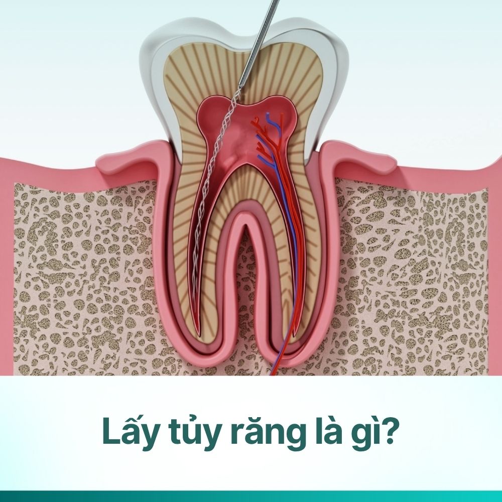 Lấy tủy răng là gì? Những điều cần biết về điều trị tủy