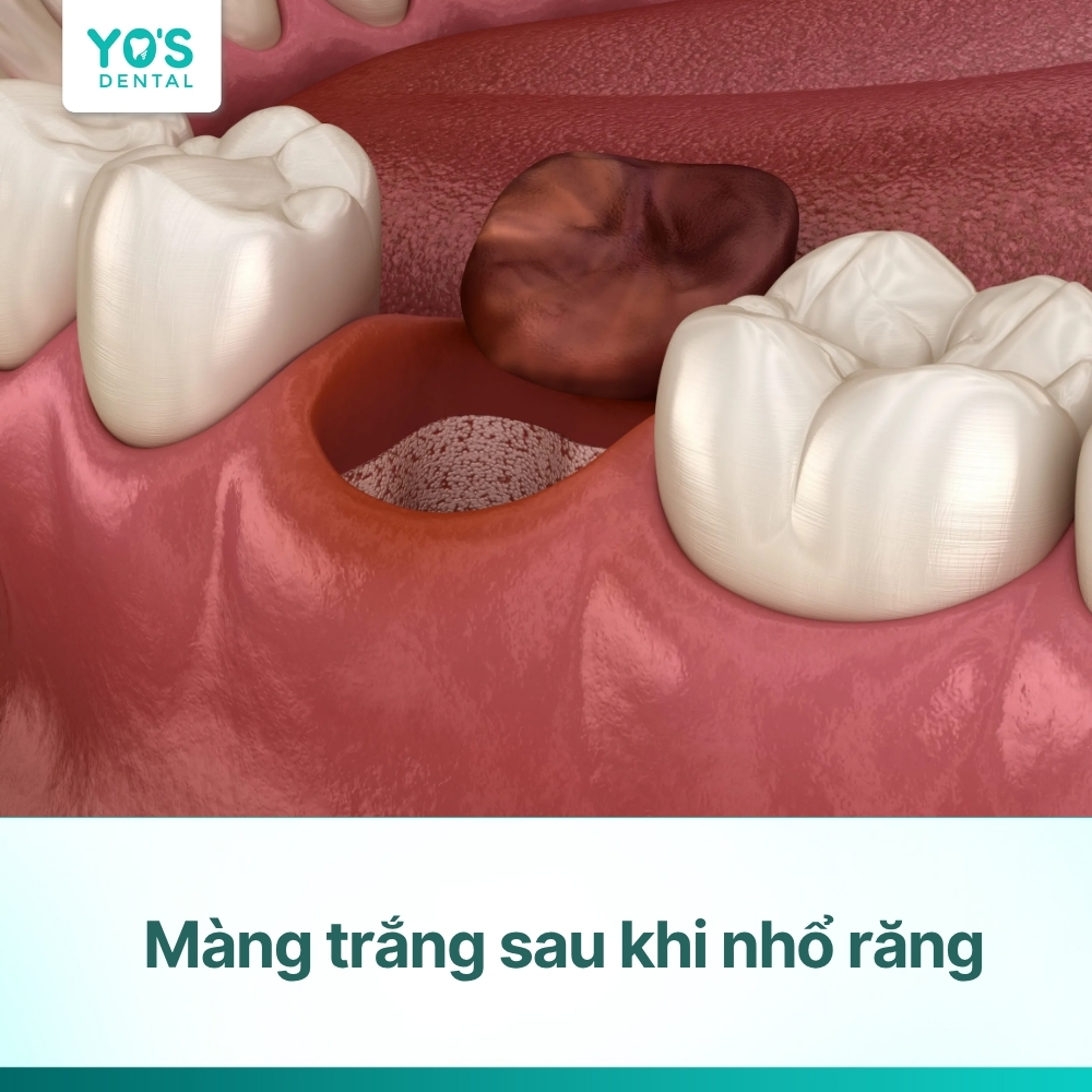 Màng trắng sau khi nhổ răng: Nguyên nhân, cách xử lý hiệu quả