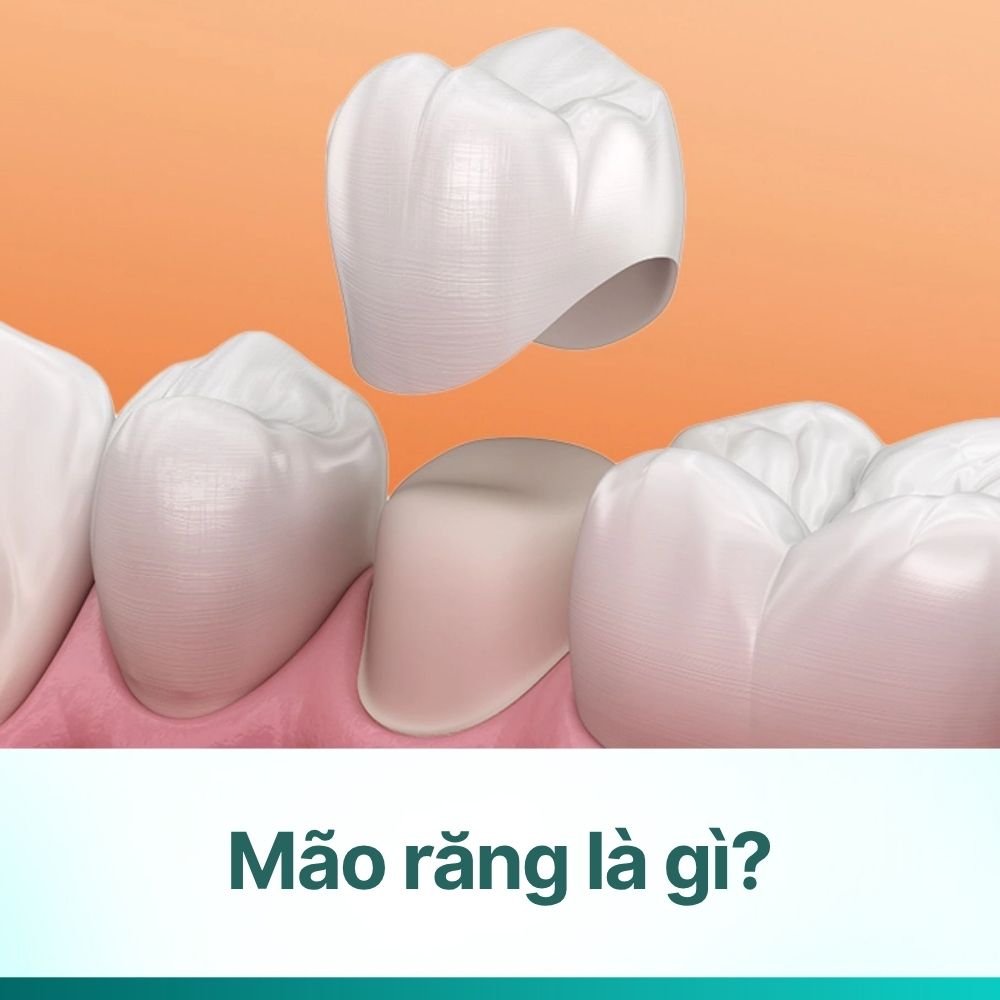 Mão răng là gì? 5 loại phổ biến và quy trình chụp mão răng