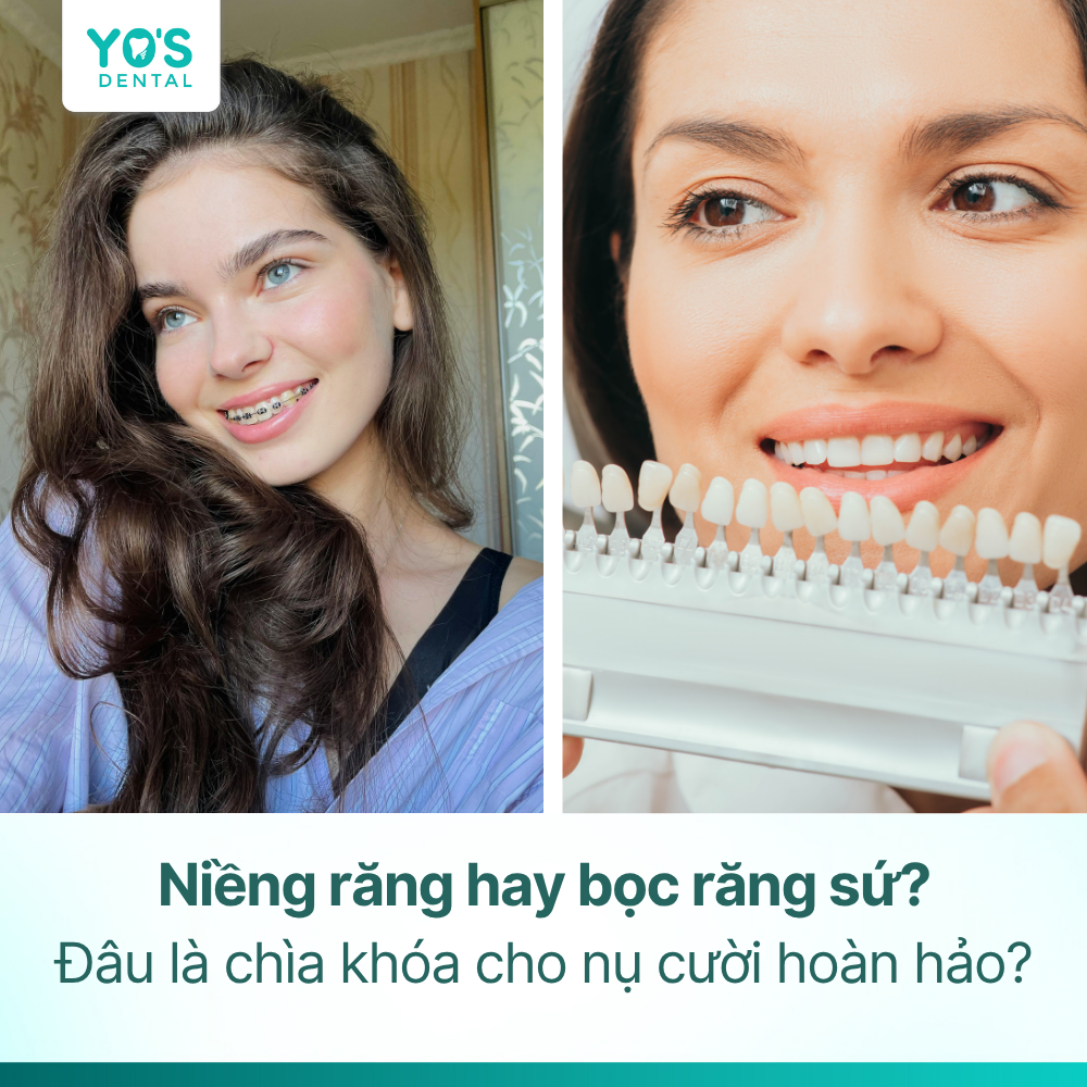 Nên niềng răng hay bọc sứ? Đâu là chìa khóa cho nụ cười hoàn hảo