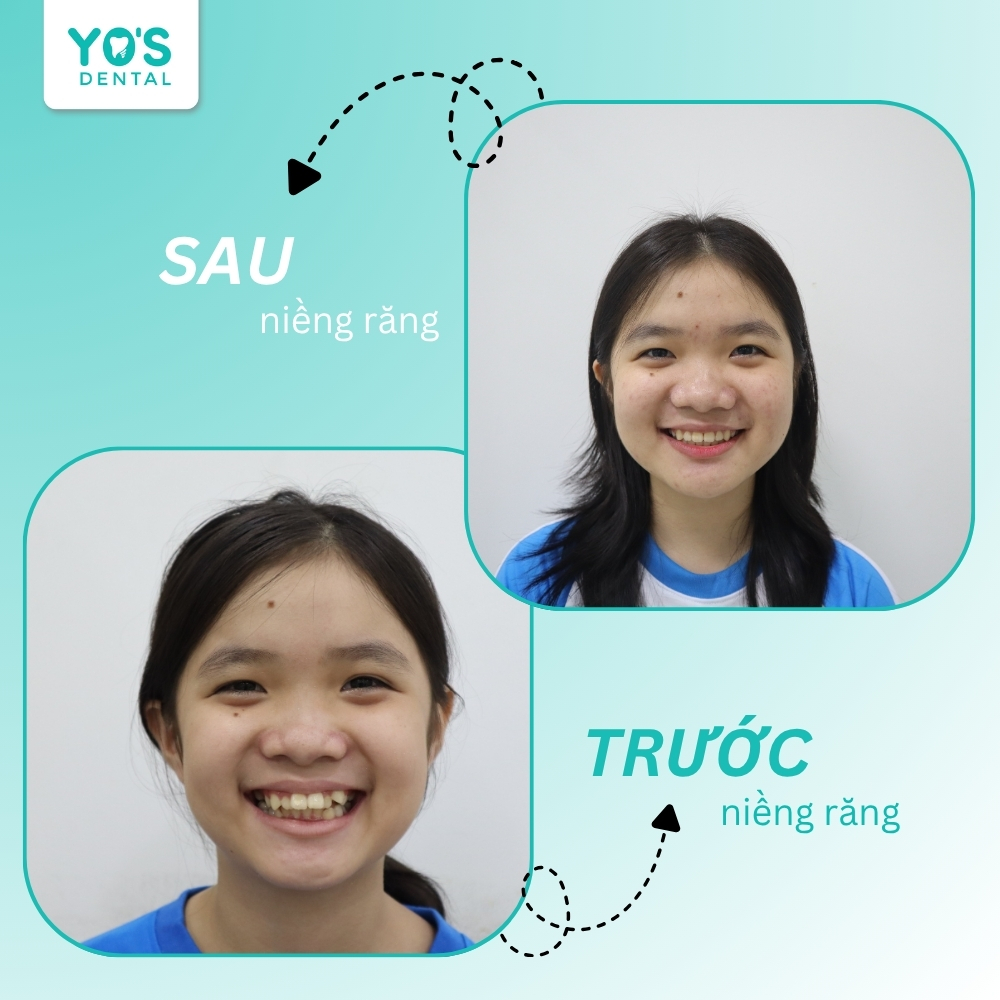 Niềng răng mắc cài phù hợp với tình trạng răng lệch lạc phức tạp và không quá chú trọng đến thẩm mỹ