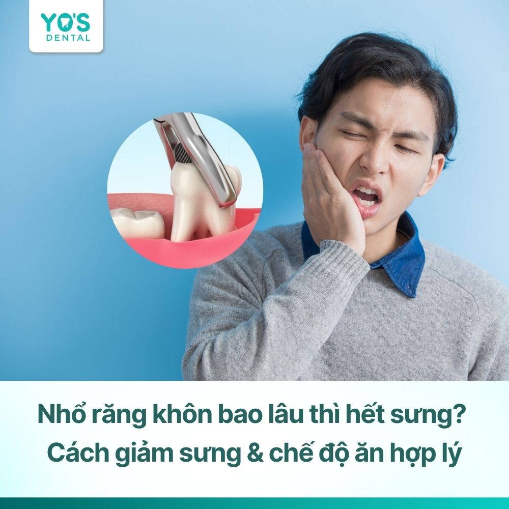 Nhổ răng khôn bao lâu thì hết sưng? Cách giảm sưng & chế độ ăn