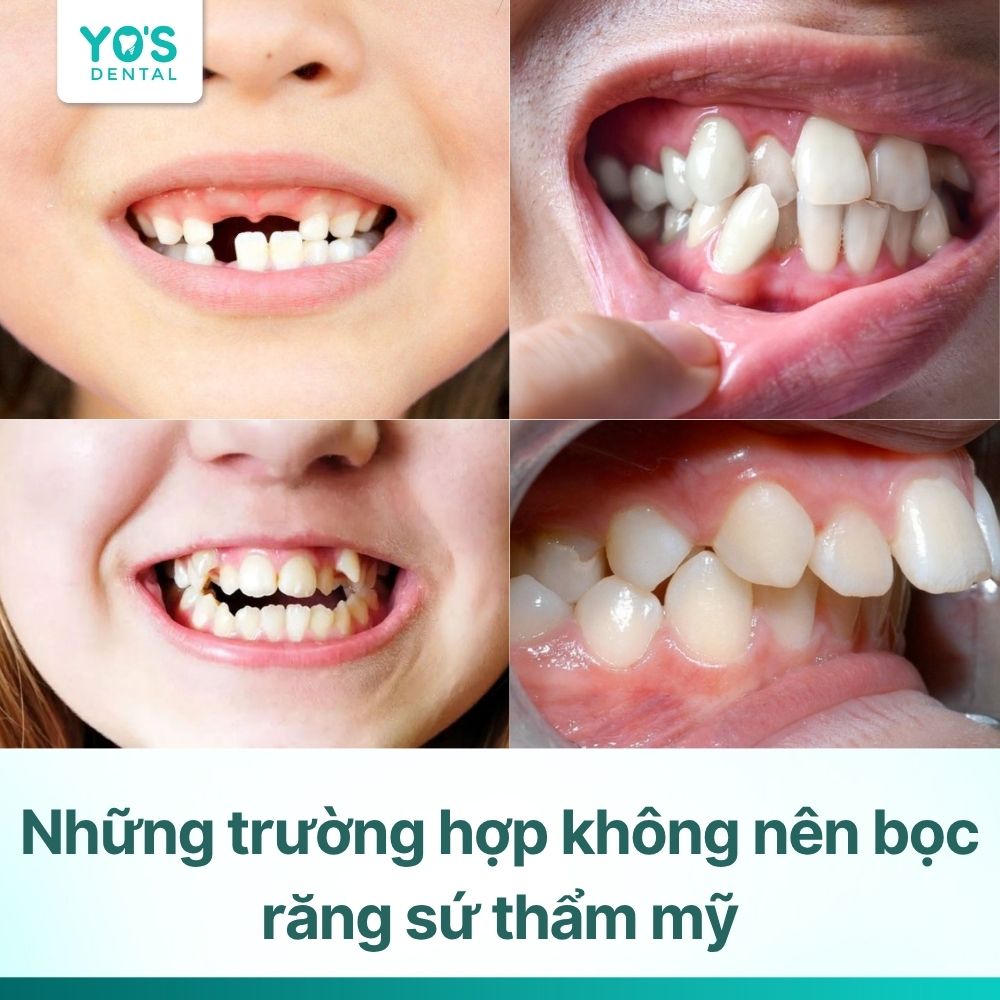 9 trường hợp không nên bọc răng sứ thẩm mỹ bạn cần biết ngay