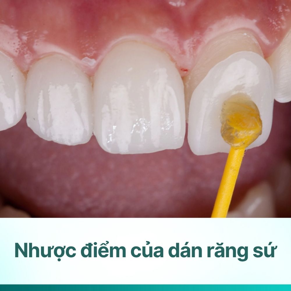 8 nhược điểm của dán răng sứ bạn cần biết trước khi thực hiện