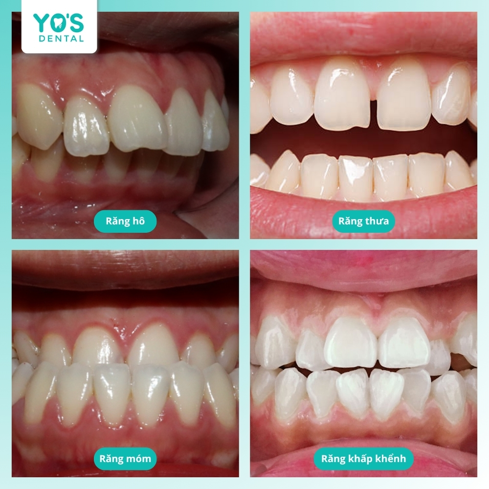 Niềng răng 1 hàm chỉ phù hợp với các tình trạng sai lệch rất nhẹ như thưa, khấp khểnh, hô hoặc móm nhẹ