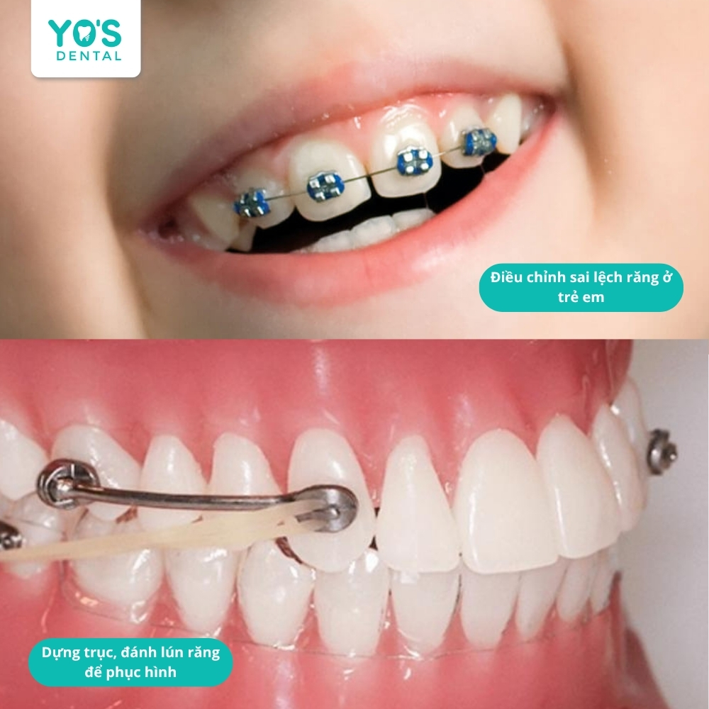 Ở trẻ em đây là giai đoạn can thiệp sớm để định hướng sự phát triển, trường hợp mất răng lâu có thể niềng răng một hàm