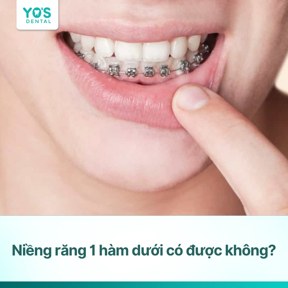 Niềng răng 1 hàm dưới có được không và hiệu quả thế nào?