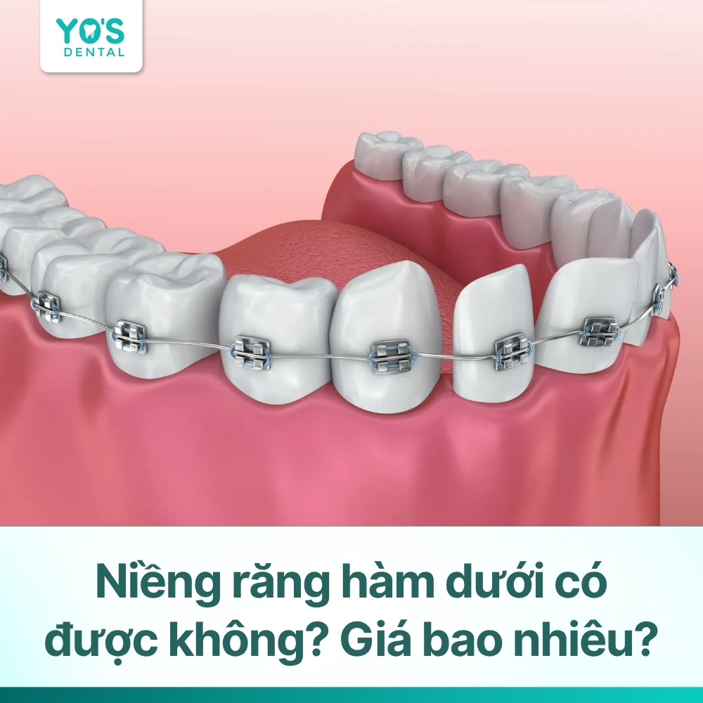 Niềng răng hàm dưới có được không? Giá bao nhiêu?