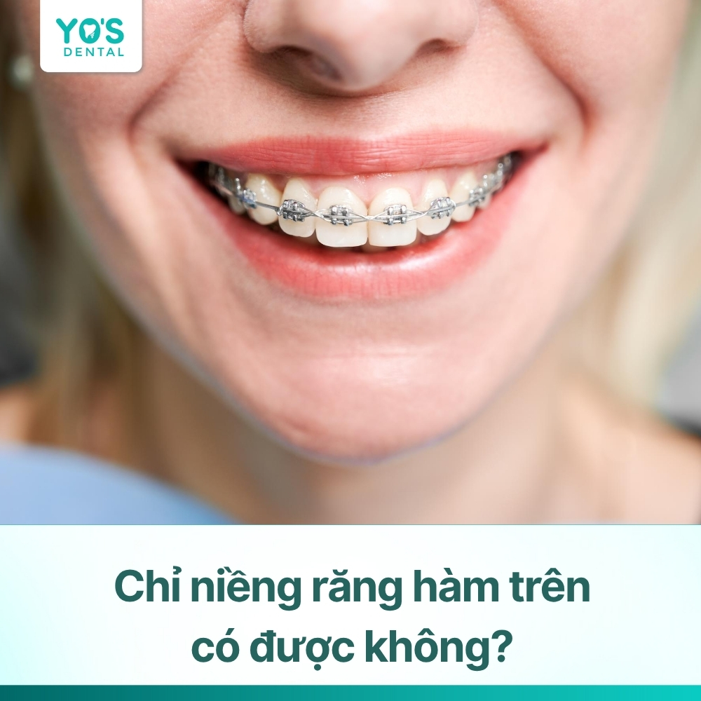 Chỉ niềng răng hàm trên có được không? Thời gian & chi phí