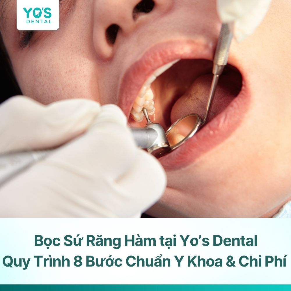 Bọc sứ răng hàm: Quy trình 8 bước chuẩn y khoa & chi phí tại Yo’s Dental