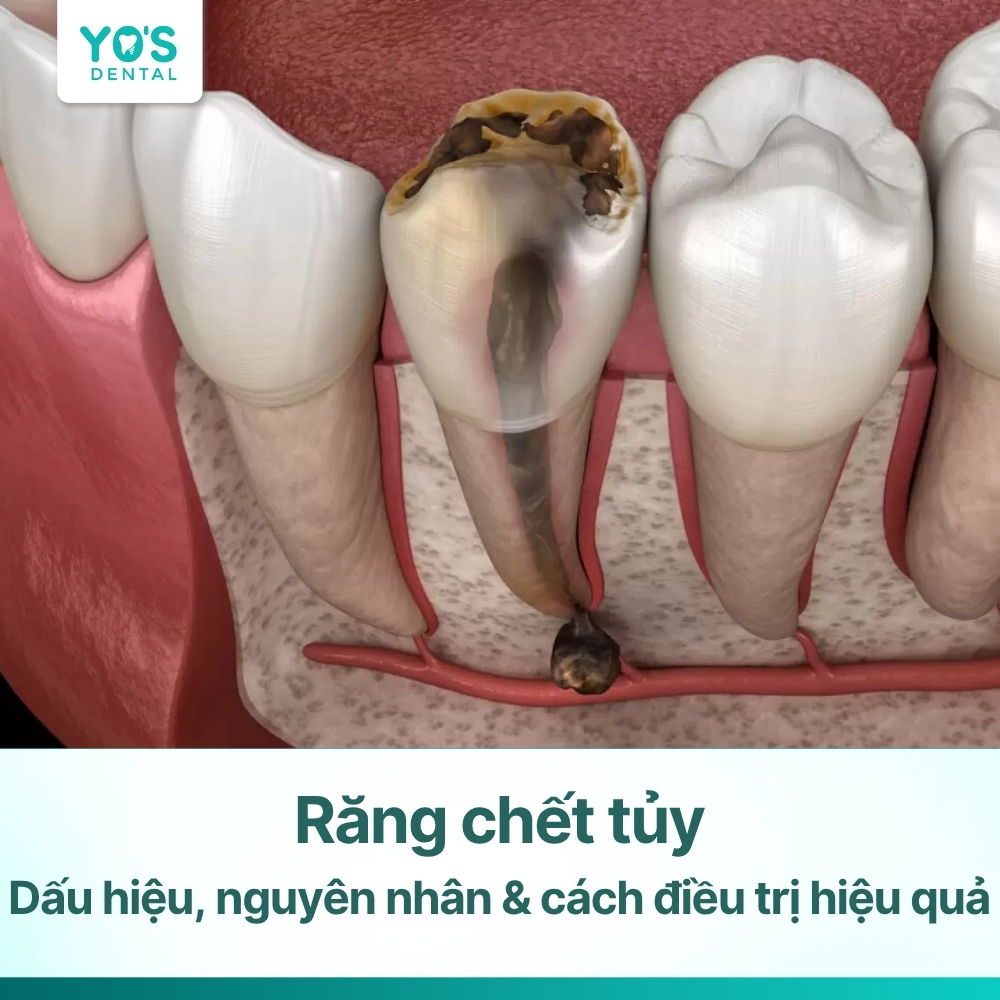 Răng chết tủy: Dấu hiệu, nguyên nhân & cách điều trị hiệu quả