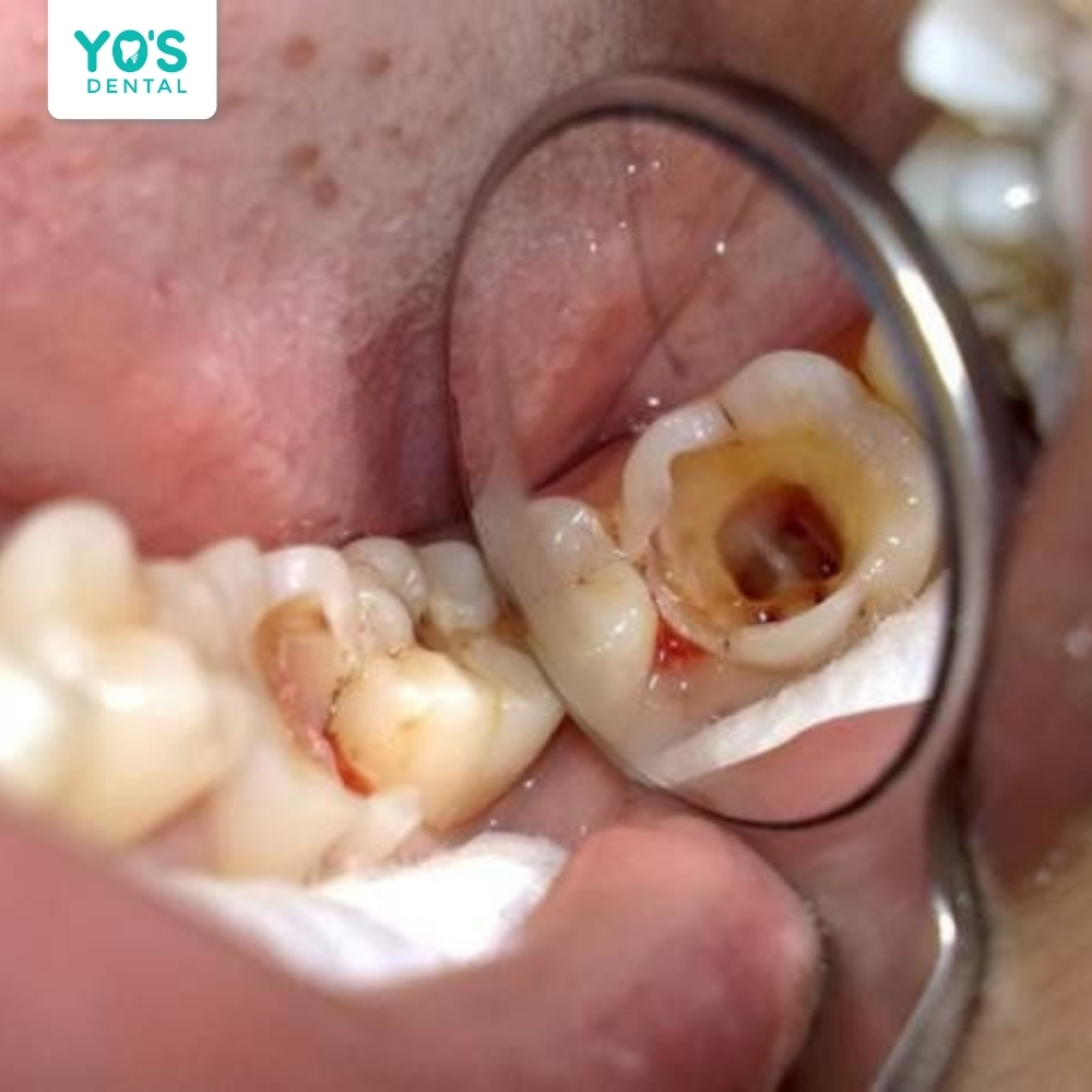 Mạch máu và dây thần kinh trong răng bị phá hủy hoàn toàn