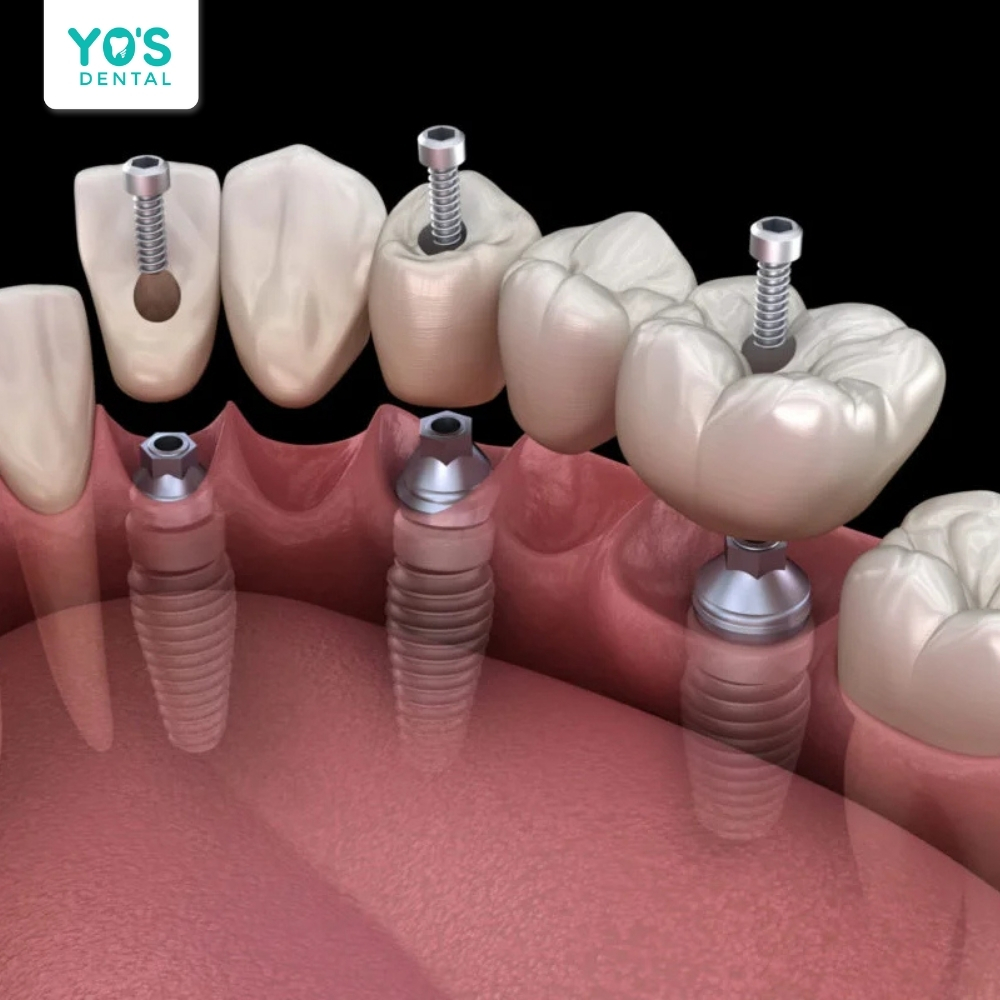 Trồng răng Implant là giải pháp tối ưu sau khi nhổ răng
