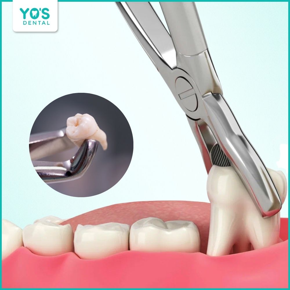 Thời điểm nhổ răng khôn lý tưởng là khi chân răng hình thành được 2/3