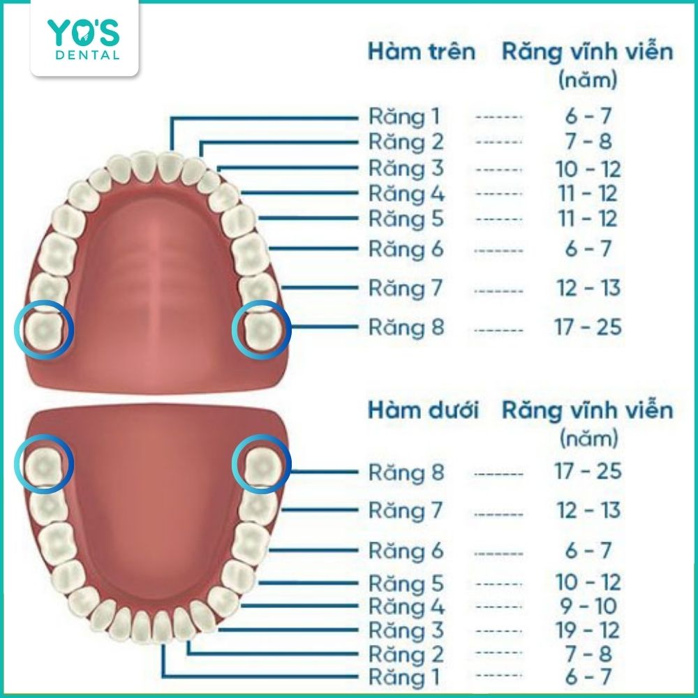 Độ tuổi mọc răng khôn phổ biến thường dao động từ 17 đến 25 tuổi